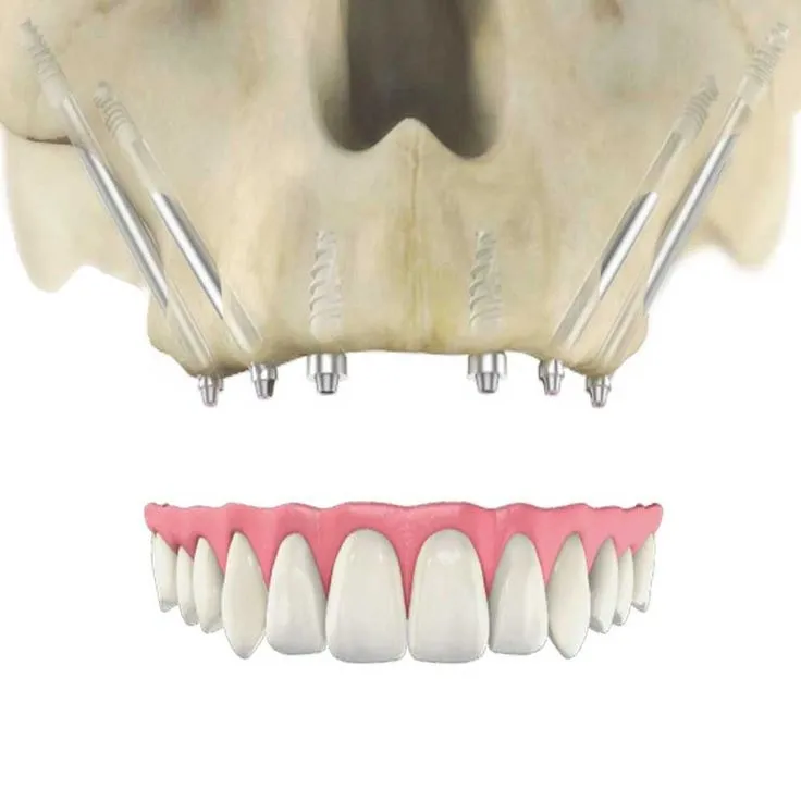 Illustration for Zygomatic Dental Implants