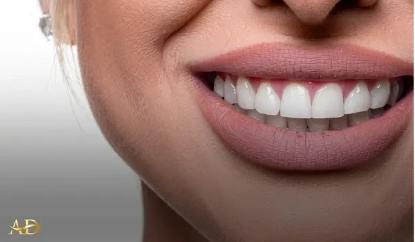 Illustration for Acrylic Crowns