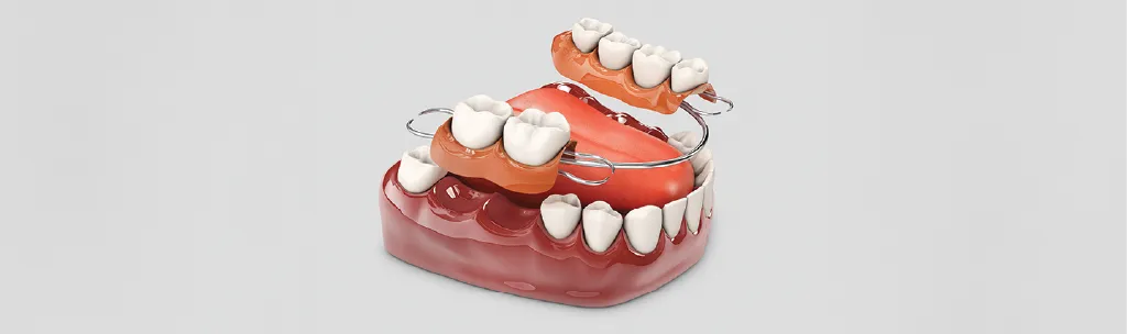Illustration for Clasped Removable Dentures