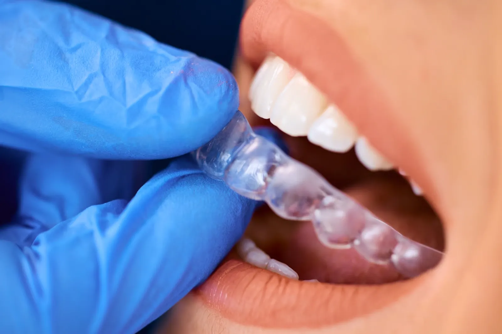 Before and after comparison of tooth shade following professional teeth whitening