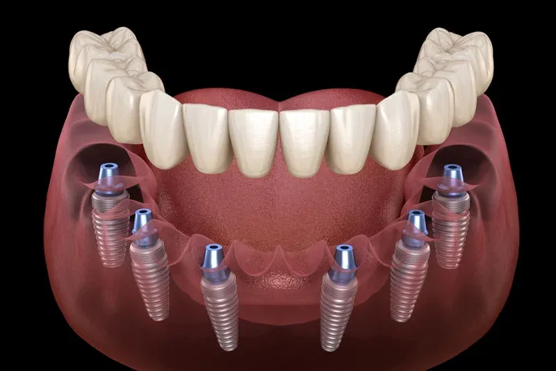 Illustration for Full Mouth Dental Implants