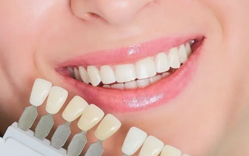 Illustration for Porcelain Laminate Veneers