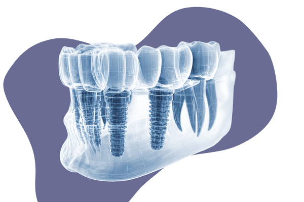 All-on-6 Dental Implant Treatment