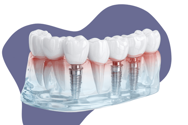 All-on-4 Dental Implant