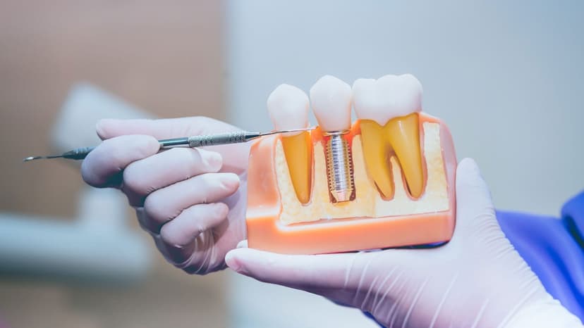 Dental Implants Turkey 1