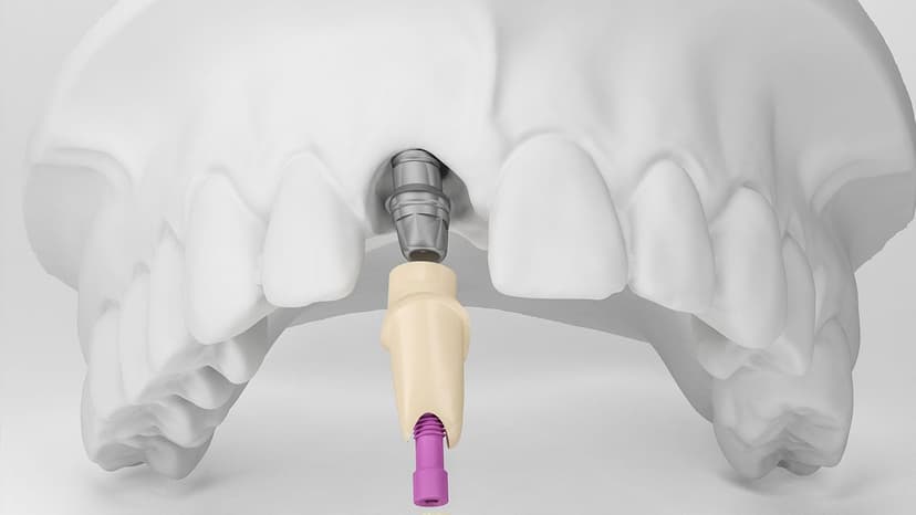 Dental Implants Turkey 2
