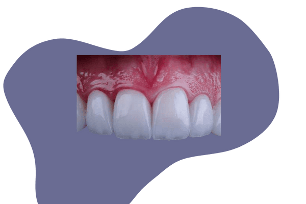 E-max Crown Treatment