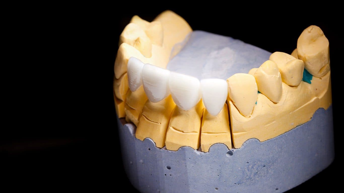 Zirconium veneers result 2