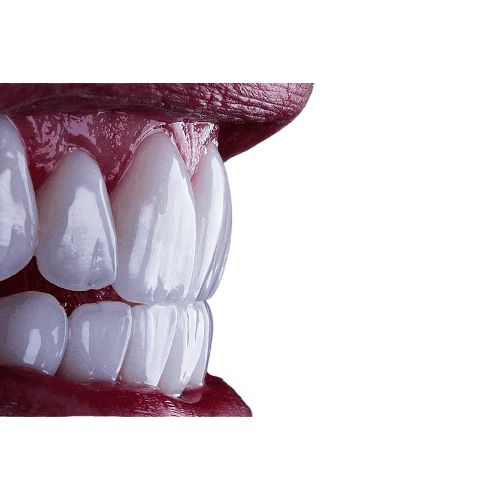 Emax Diş Kaplamaları