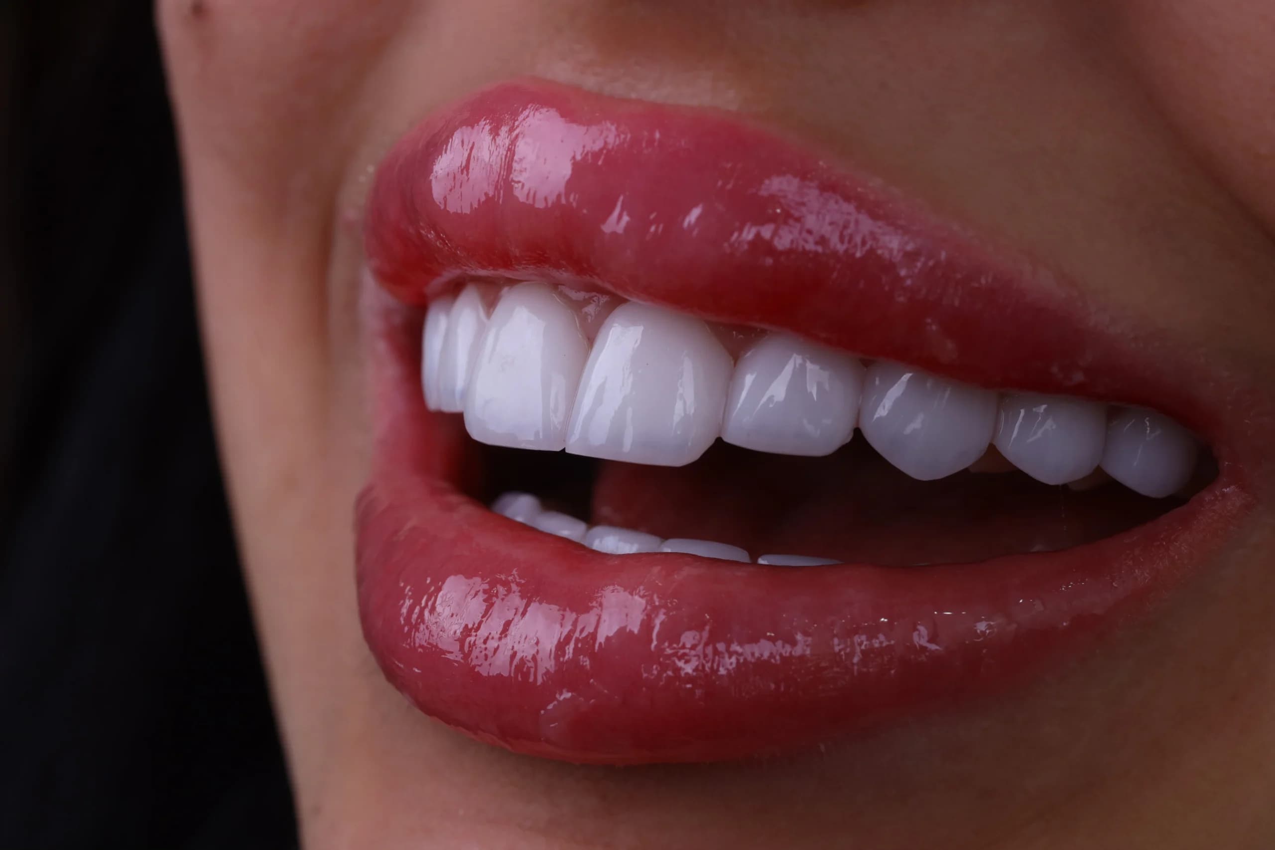 Hollywood Smile