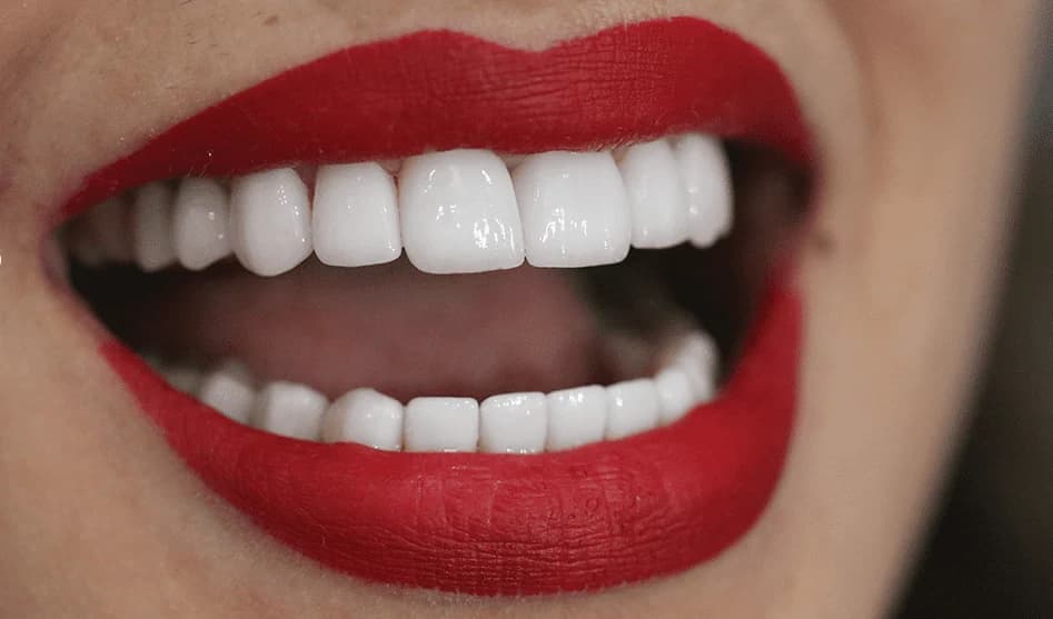 Dijital gülüş tasarımı ile planlanan Hollywood Smile tedavisi