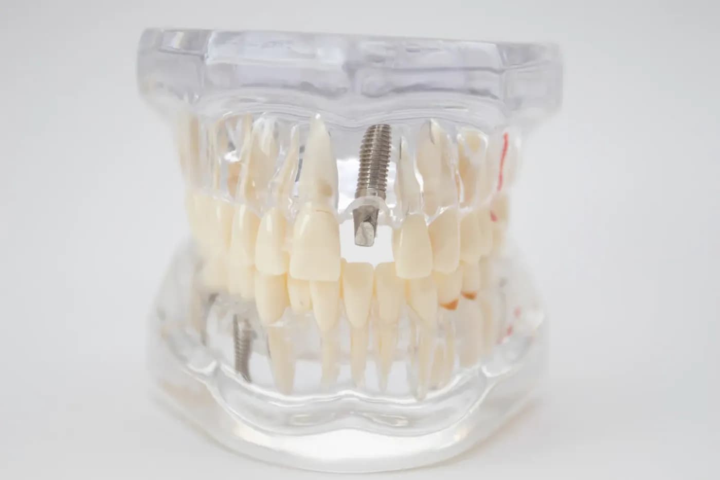Osstem dantų implantų sistemos vaizdas