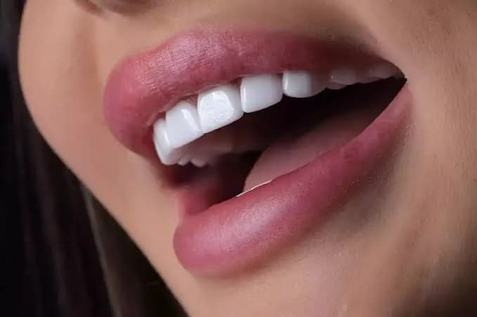 Diş eti kontur düzenlemesini gösteren görünüm