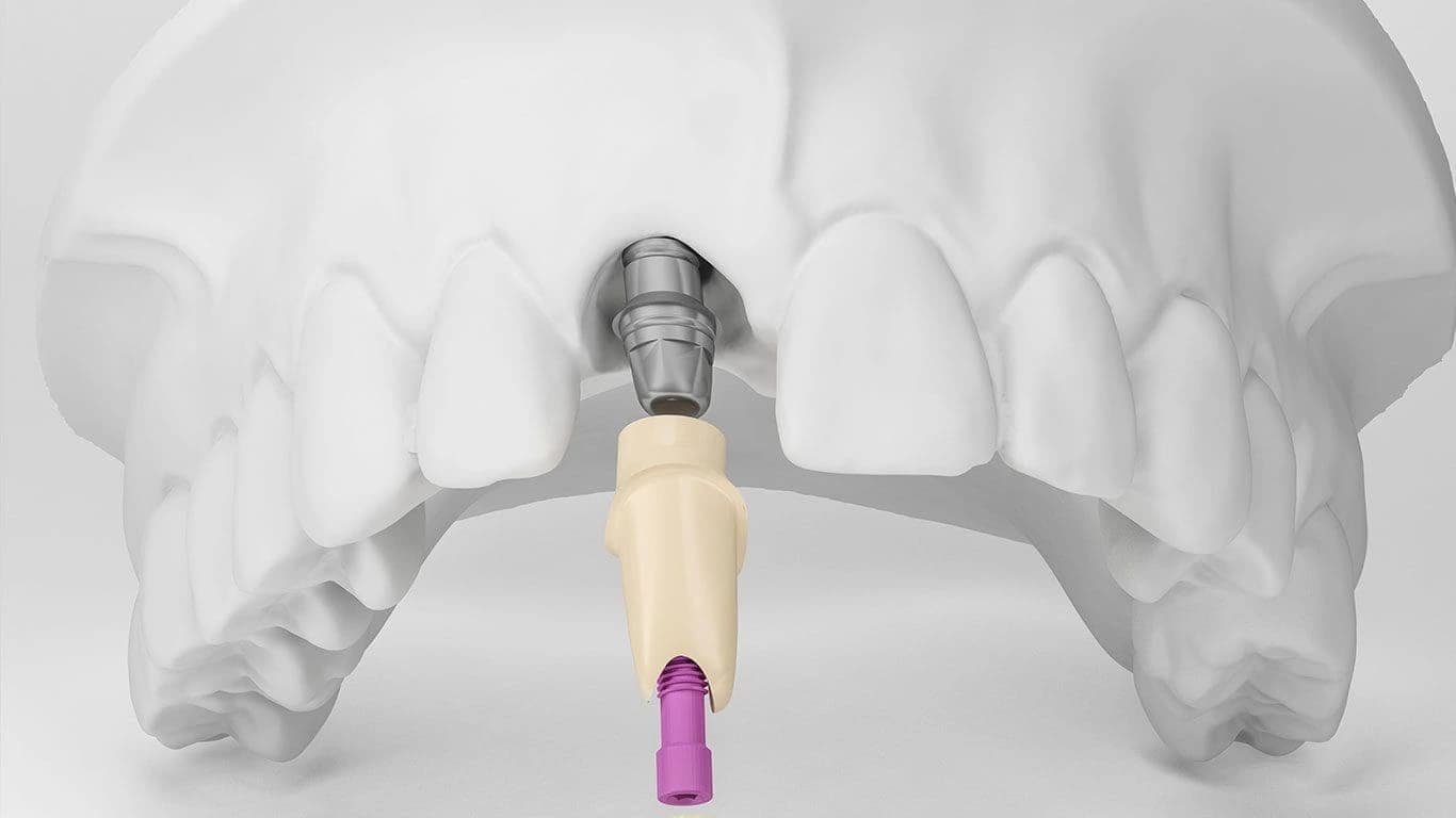 Alt çenede yerleştirilmiş bir diş implantının üç boyutlu kesit görünümü