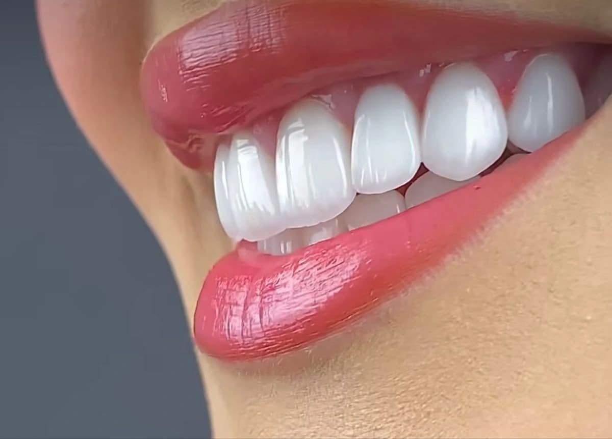 Hollywood Smile tedavisi sırasında diş hazırlığı yapan diş hekimi