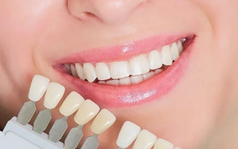 Porselen lamina uygulanmış ön dişlerin yakın çekim görüntüsü