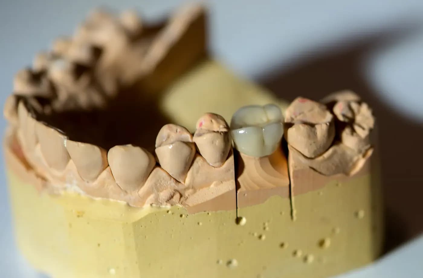 Dental veneer treatment planning and digital smile design view