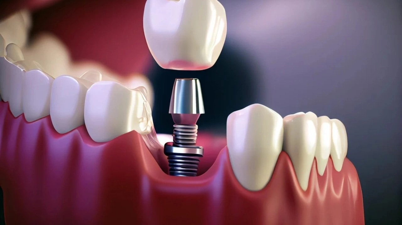 Illustration for Aggressive Dental Implants