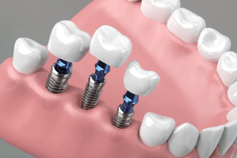 Aggressive Dental Implants