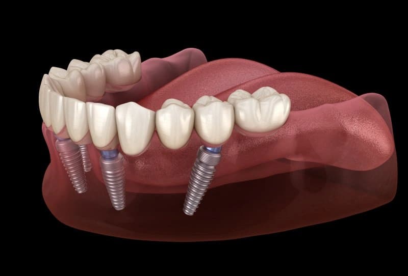 All on 4 tekniğiyle çeneye açılı olarak yerleştirilmiş dört diş implantının şematik görünümü