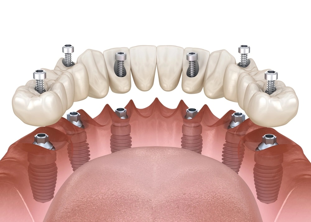 Schéma de six implants dentaires placés dans la mâchoire selon la technique All-on-6