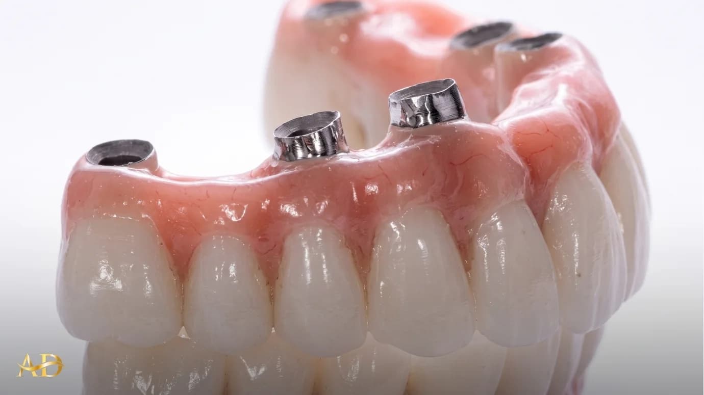 Implants dentaires All-on-6