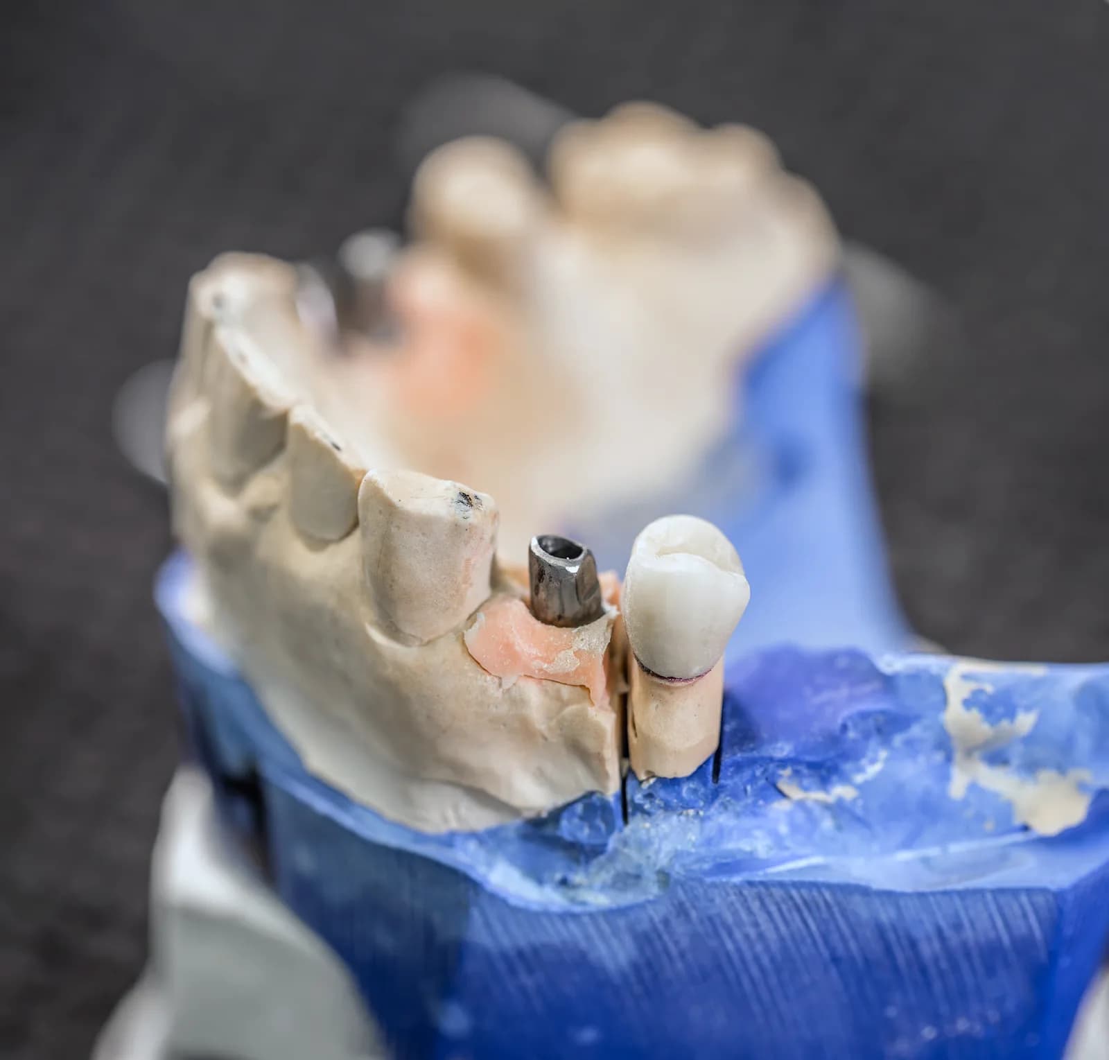 Illustration d'implant dentaire sur fond du littoral d'Alanya, Antalya