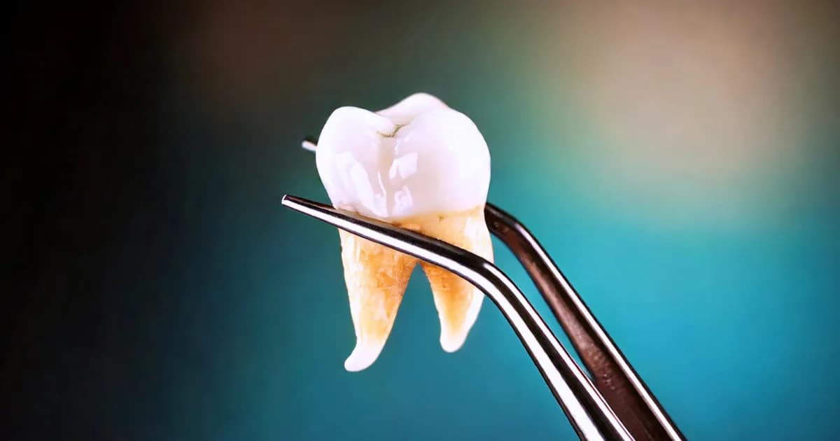 Intraoral view before and after a tooth extraction procedure