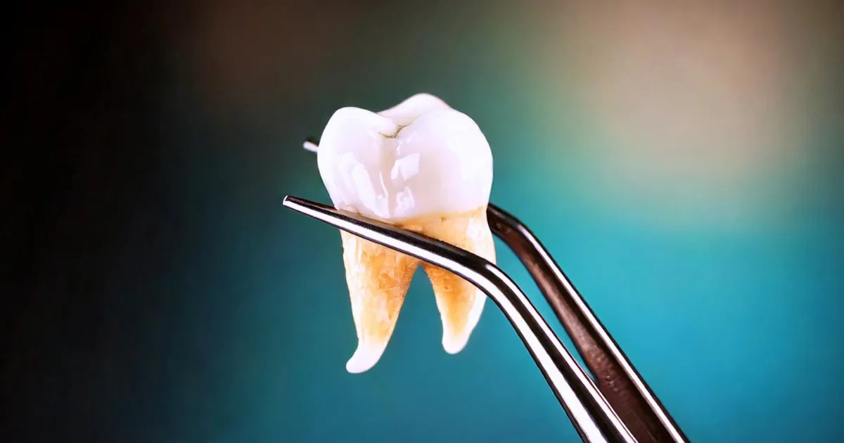 Vue intra-orale avant et après une extraction dentaire