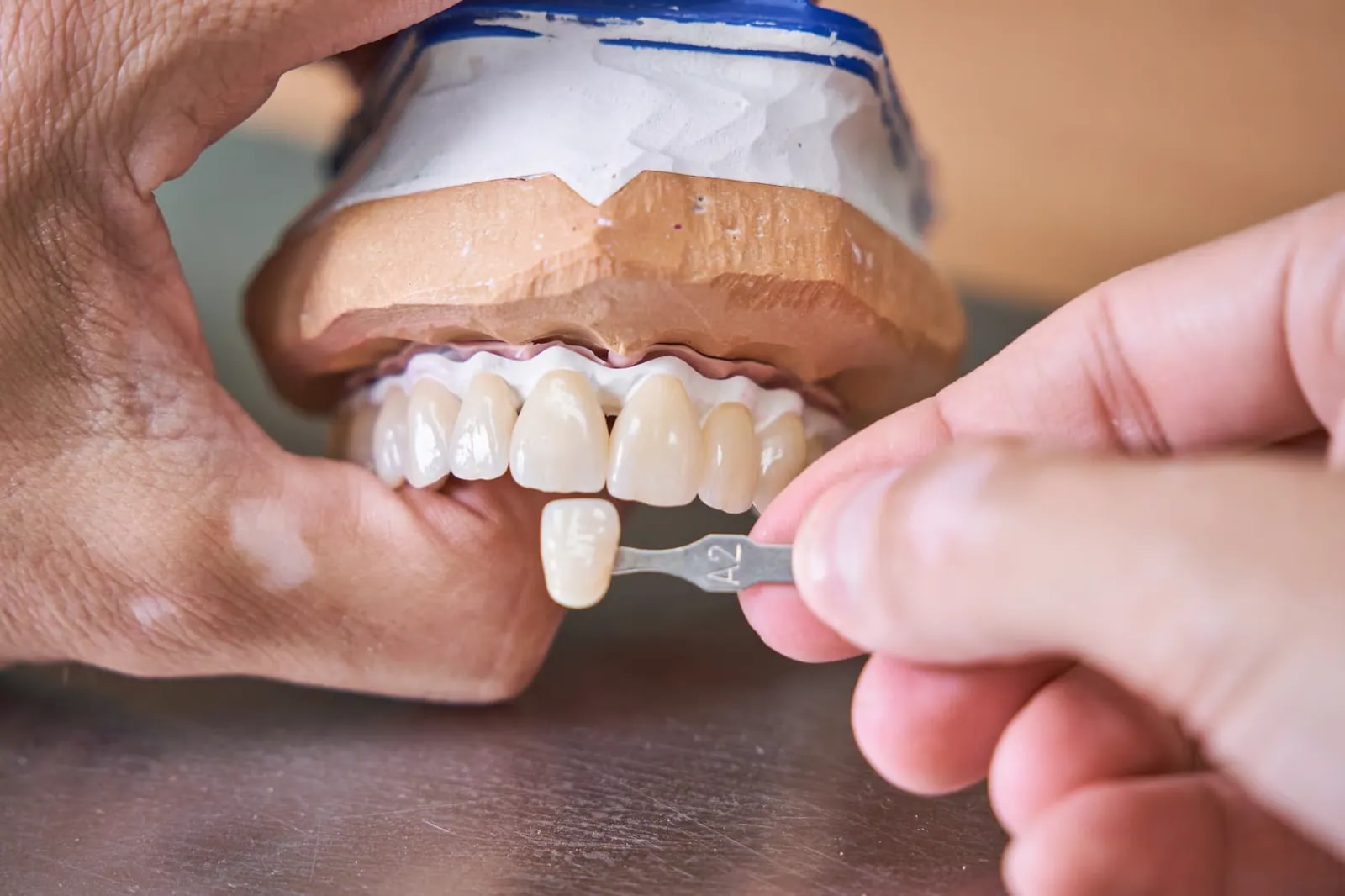 Gros plan de dents antérieures restaurées avec des facettes E.max Empress