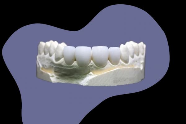 Metallkeramik (VMK)