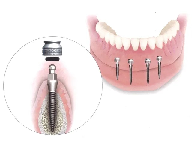 Illustration de mini-implants étroits stabilisant une prothèse de mâchoire inférieure