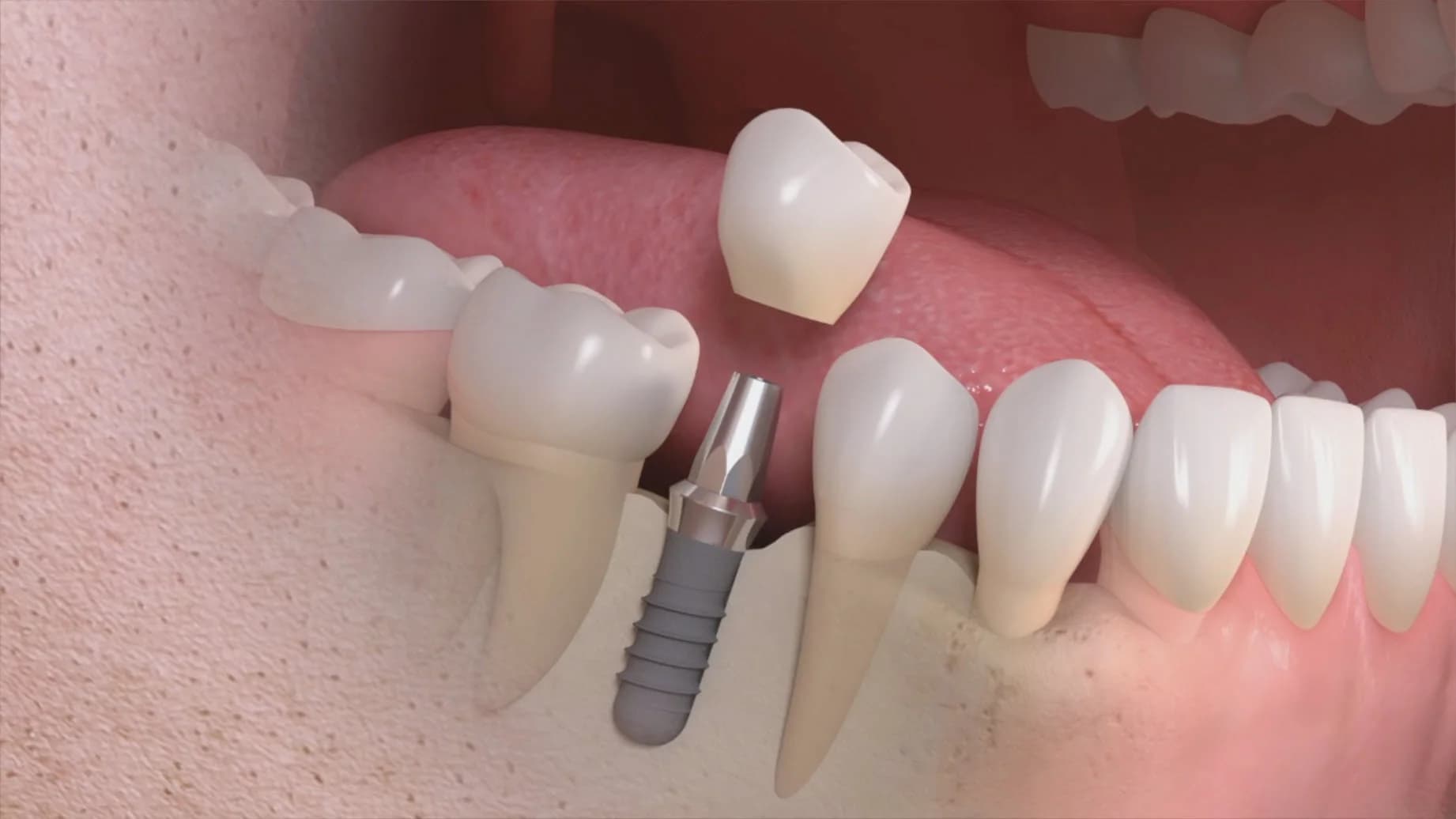 Mini-implants dentaires