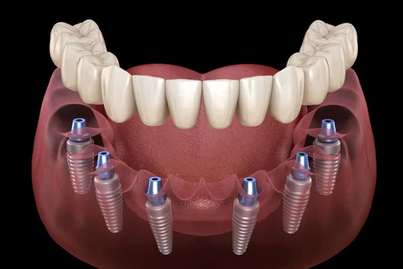 Tam ağız diş implantı tedavi seçeneklerini gösteren şematik görünüm