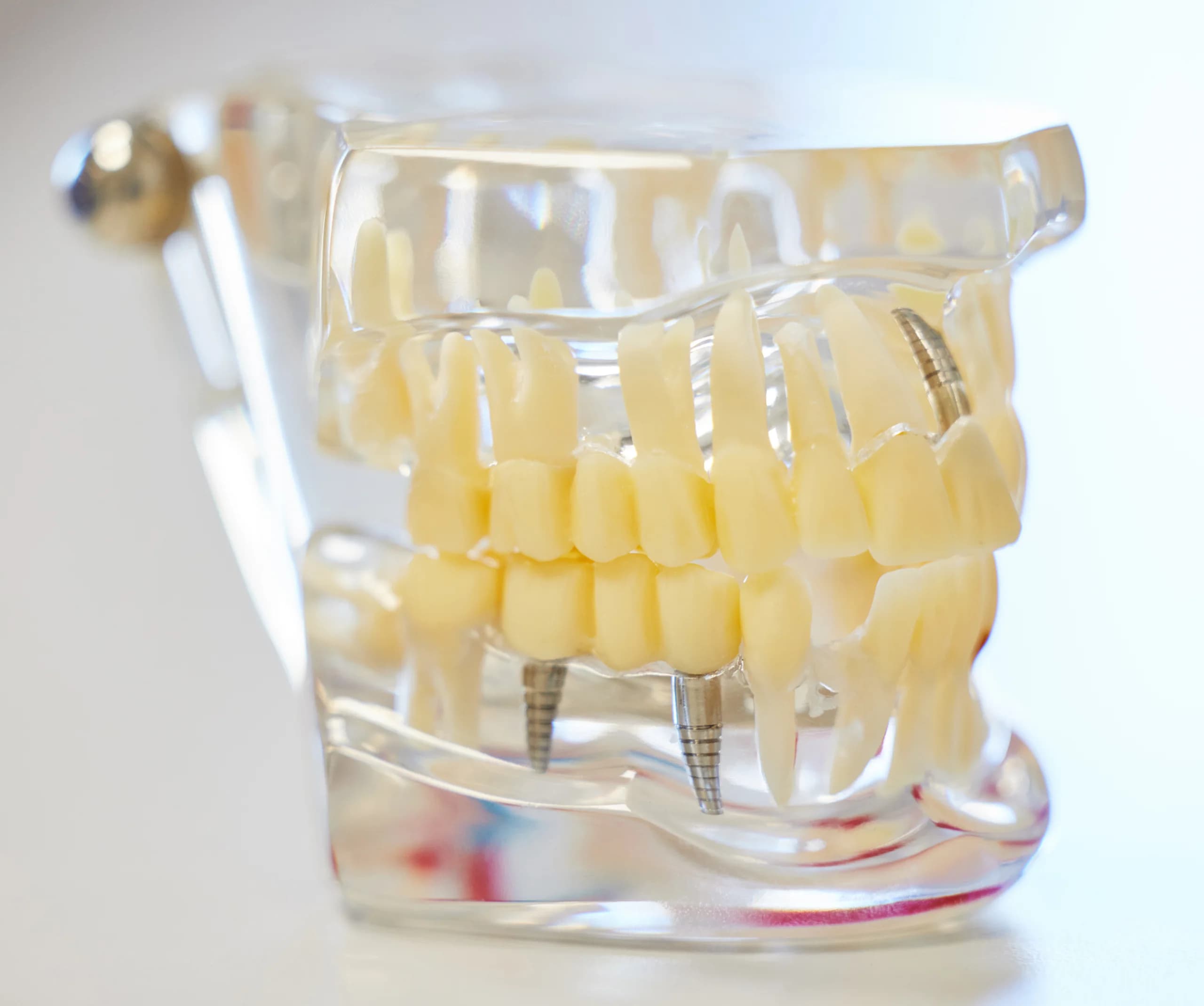 Tam Ağız Diş İmplantları — generic-3