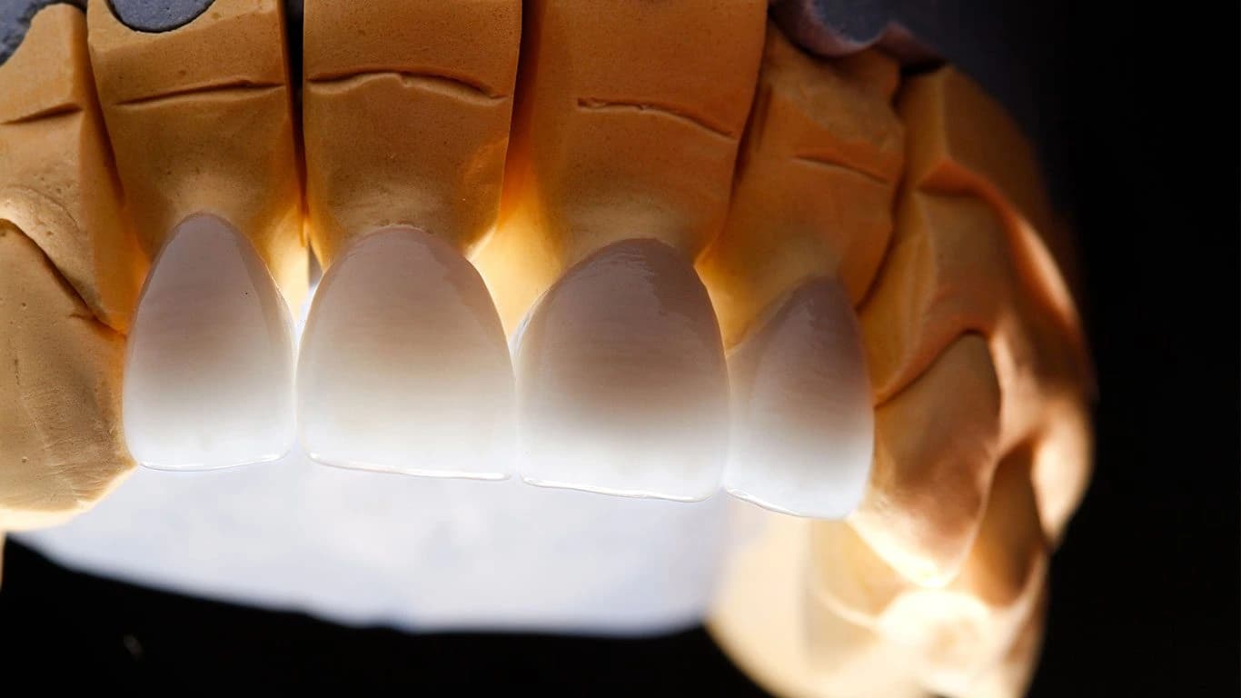 Corone in zirconia